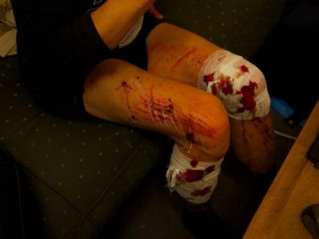 У одного из журналистов разорвалась в ногах граната с газом от милиции. Фото ‏@Dbnmjr на ЄвроМайдан