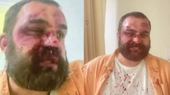 У Грузії нападають на опозиційних політиків та активістів: щонайменше 4 постраждалих 
